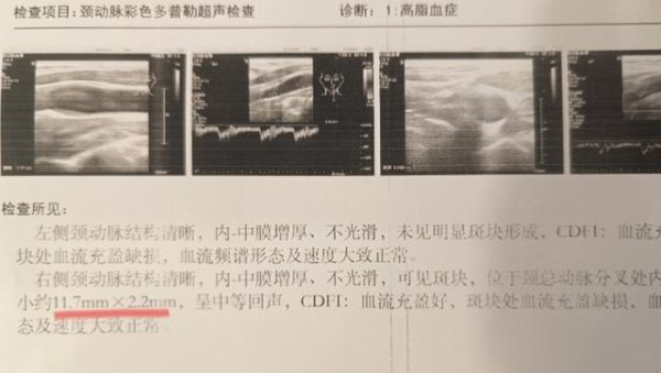 股票配资服务 医生坦言：只要体检里没这1个箭头，颈动脉斑块风险就不用太焦虑
